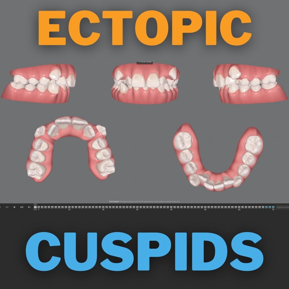 Ectopic cuspids