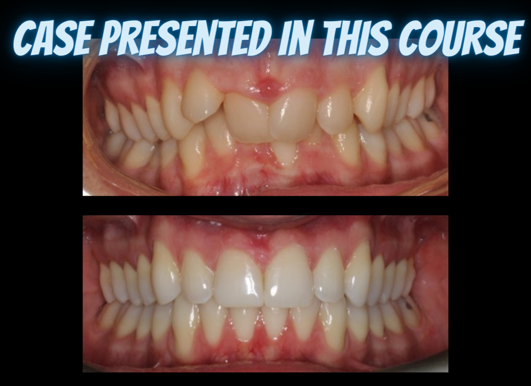 Class II treatments with clear aligners