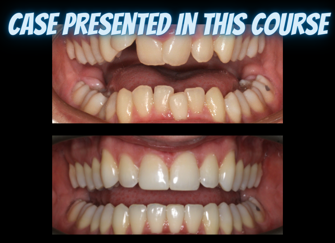 Class II treatments with clear aligners