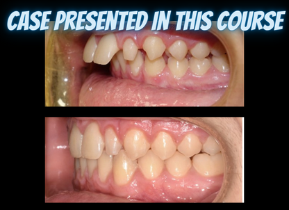 Class II treatments with clear aligners