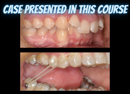 Class II treatments with clear aligners